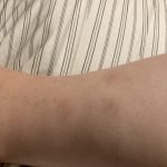 Beurer BR60 Insect Sting and Bite Relief. Bug Bite Healer for Chemical-Free Treatment of Insect Bites. Non-Toxic Natural Relief from Itching and Swelling. for Mosquito Bites